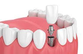 dental implants | Dentist in Blacksburg, VA | Cosmetic Smile Center